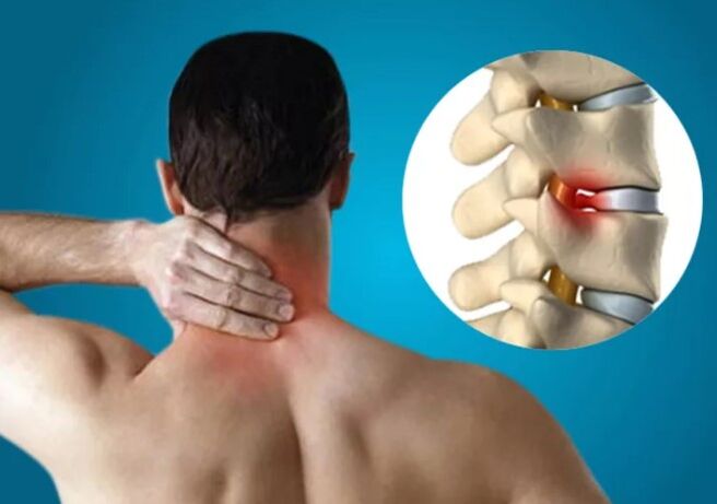 Osteocondrosi cervicale