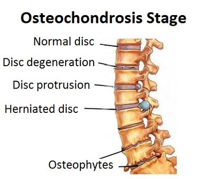 Fase di osteocondrosi