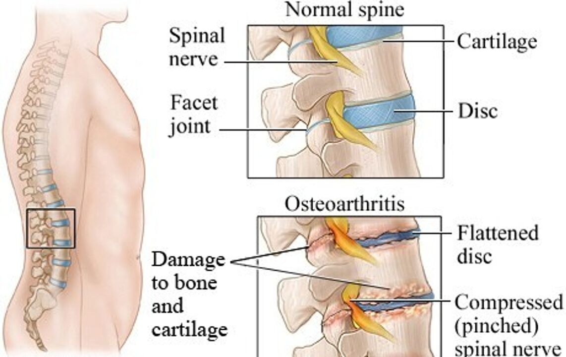 La differenza tra un disco sano e un disco con osteocondosi