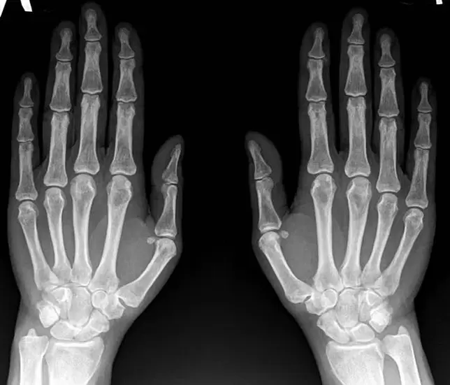 artrite dell'articolazione del polso ai raggi X prima di utilizzare Hondroine